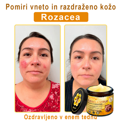 👩‍⚕️Sinvie® krema s čebeljim strupom | 50 ml | Profesionalna formula za nego in obnovo kože