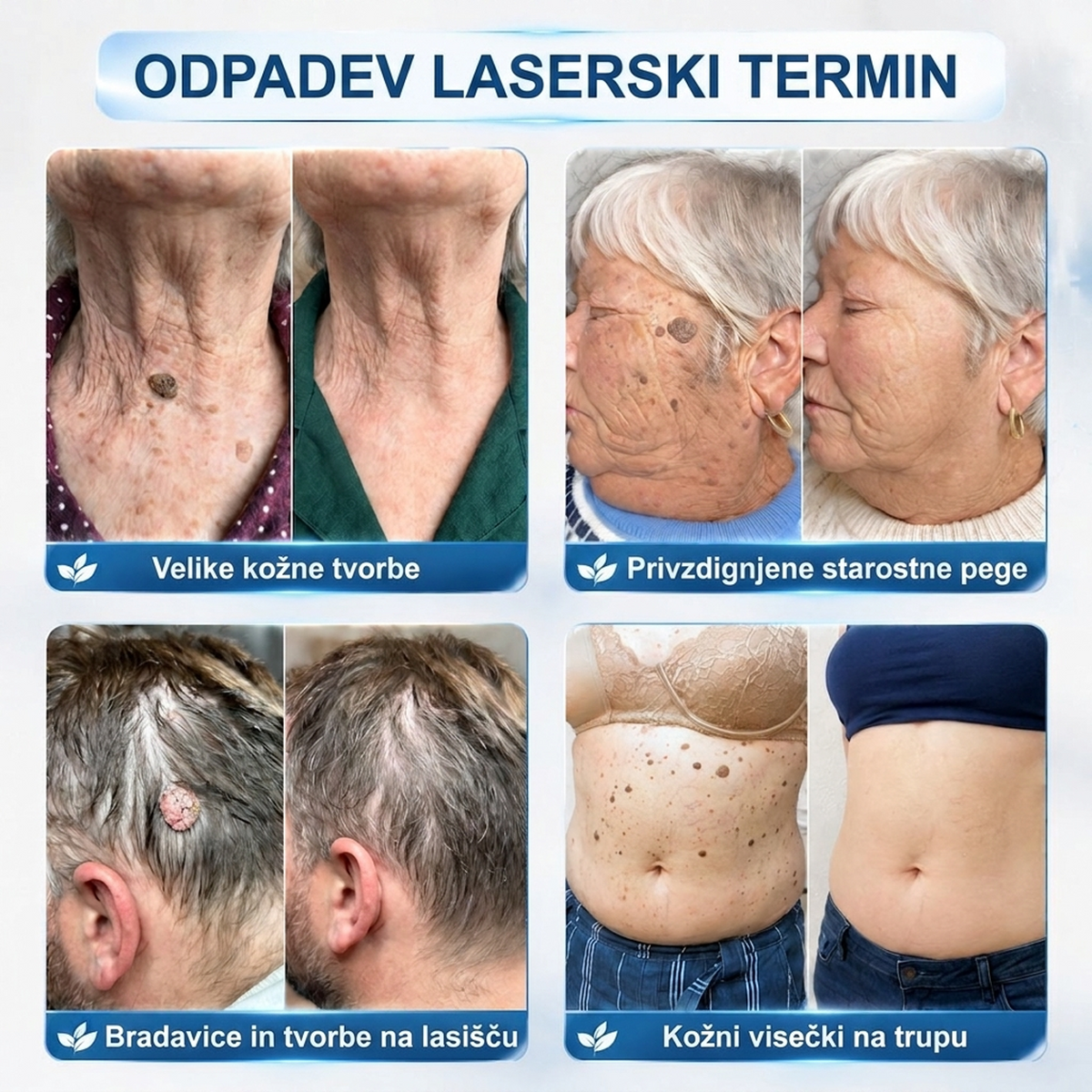 PuraCure®👩‍⚕️ 👩‍⚕️👩‍⚕️Rezultati so vidni že v 7 dneh! Valjček za odstranjevanje bradavic in drugih kožnih težav | Neboleče in minimalno razmaže.