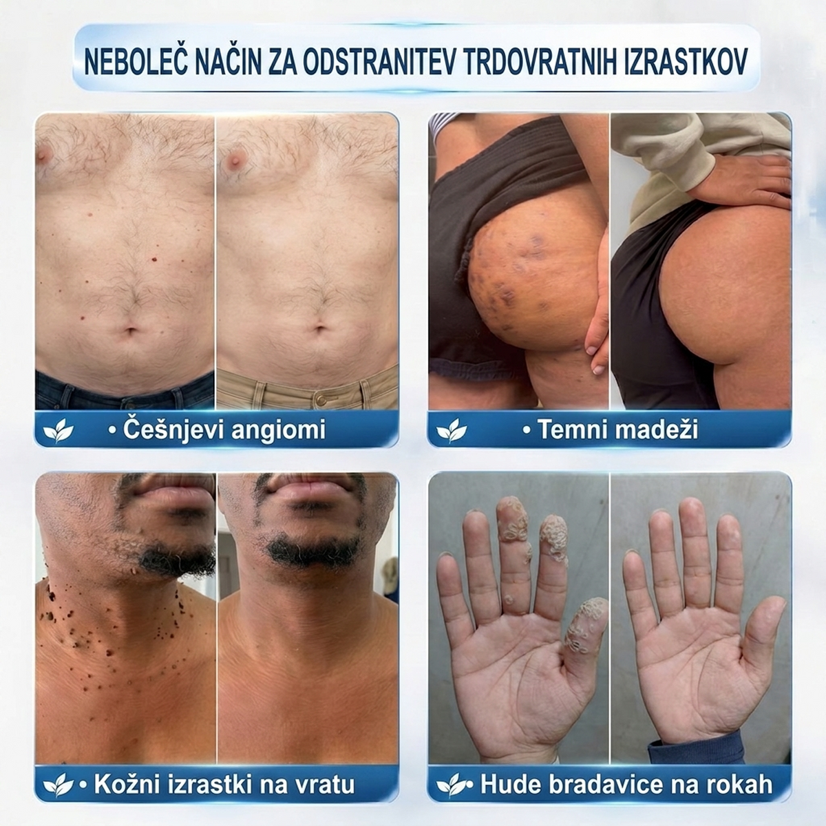 PuraCure®👩‍⚕️ 👩‍⚕️👩‍⚕️Rezultati so vidni že v 7 dneh! Valjček za odstranjevanje bradavic in drugih kožnih težav | Neboleče in minimalno razmaže.