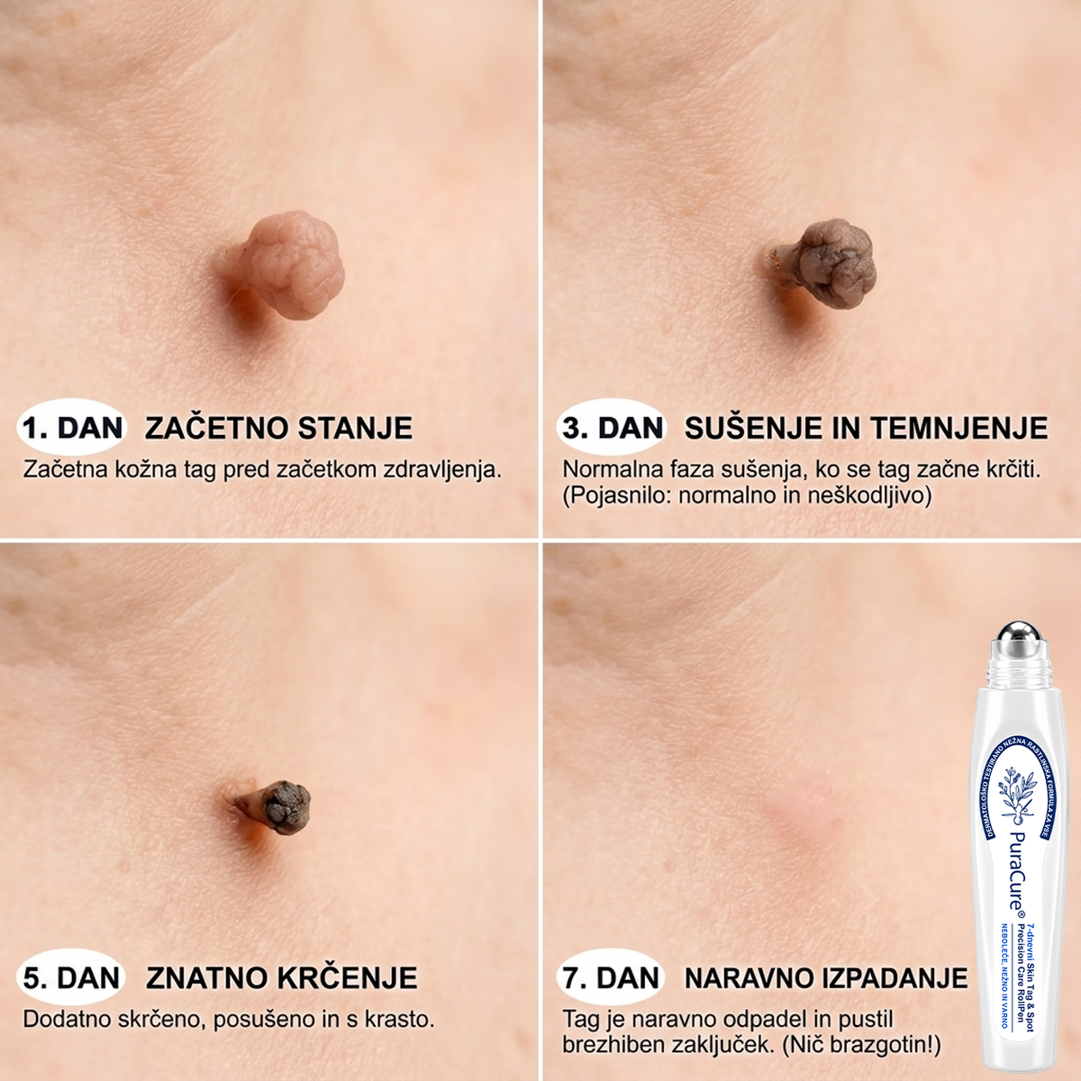 PuraCure®👩‍⚕️ 👩‍⚕️👩‍⚕️Rezultati so vidni že v 7 dneh! Valjček za odstranjevanje bradavic in drugih kožnih težav | Neboleče in minimalno razmaže.